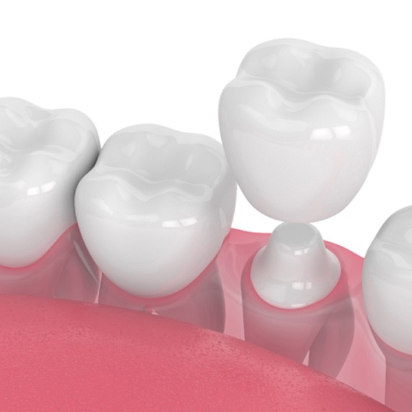 Illustration of teeth receiving dental crowns in Hingham, MA