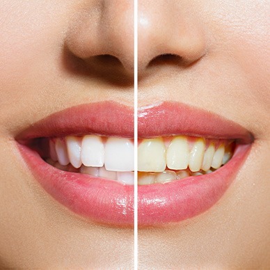 Closeup of a woman’s smile that’s split in half to show the impact of whitening